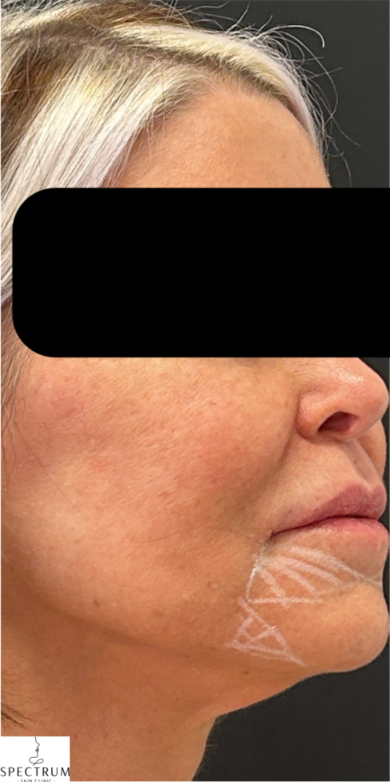 Chin Filler, Marionette Filler before — Marionette Lines, Weak Chin, Lower Face Definition, Lower Face Sagging, front view