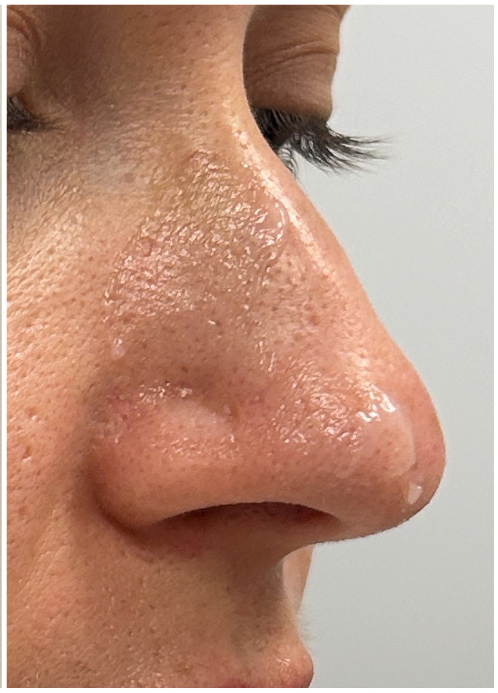 Nasal Filler Dissolve after — Filler Migration, Nasal Contour Distortion, Over-Filled Nose, front view