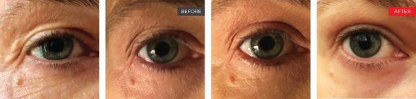 Laser Under-Eye Tightening Before and After