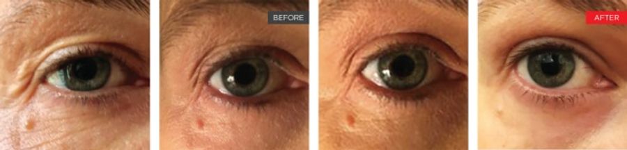 Laser Under-Eye Tightening Before and After