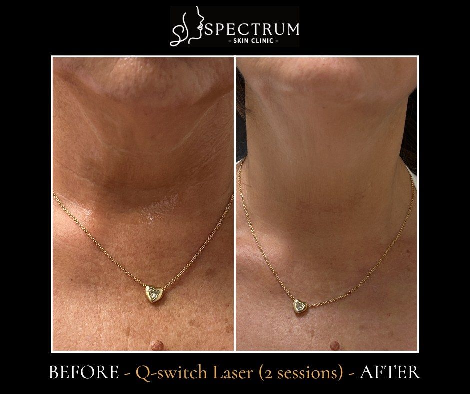Q-Switch Laser Before & After | Neck and Chest Sun Damage