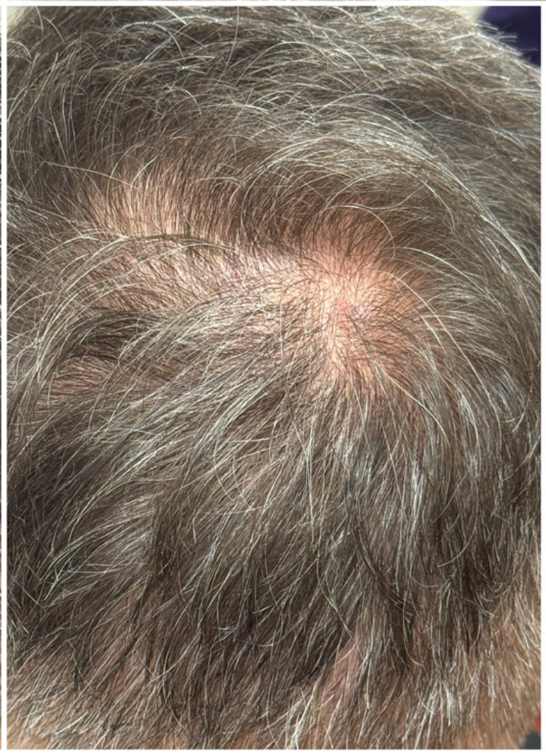 Exosome Hair Therapy after — Early-Stage Crown Thinning, Mild Hair Loss, Vertex Density Loss, front view