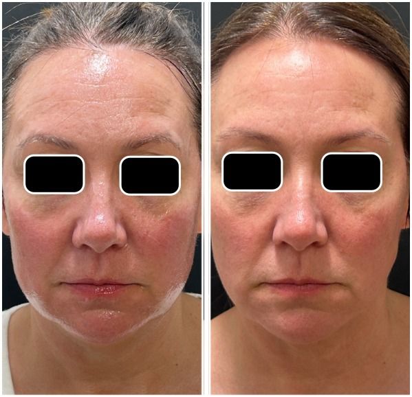 Light & Bright IPL Before & After | Tone and Clarity