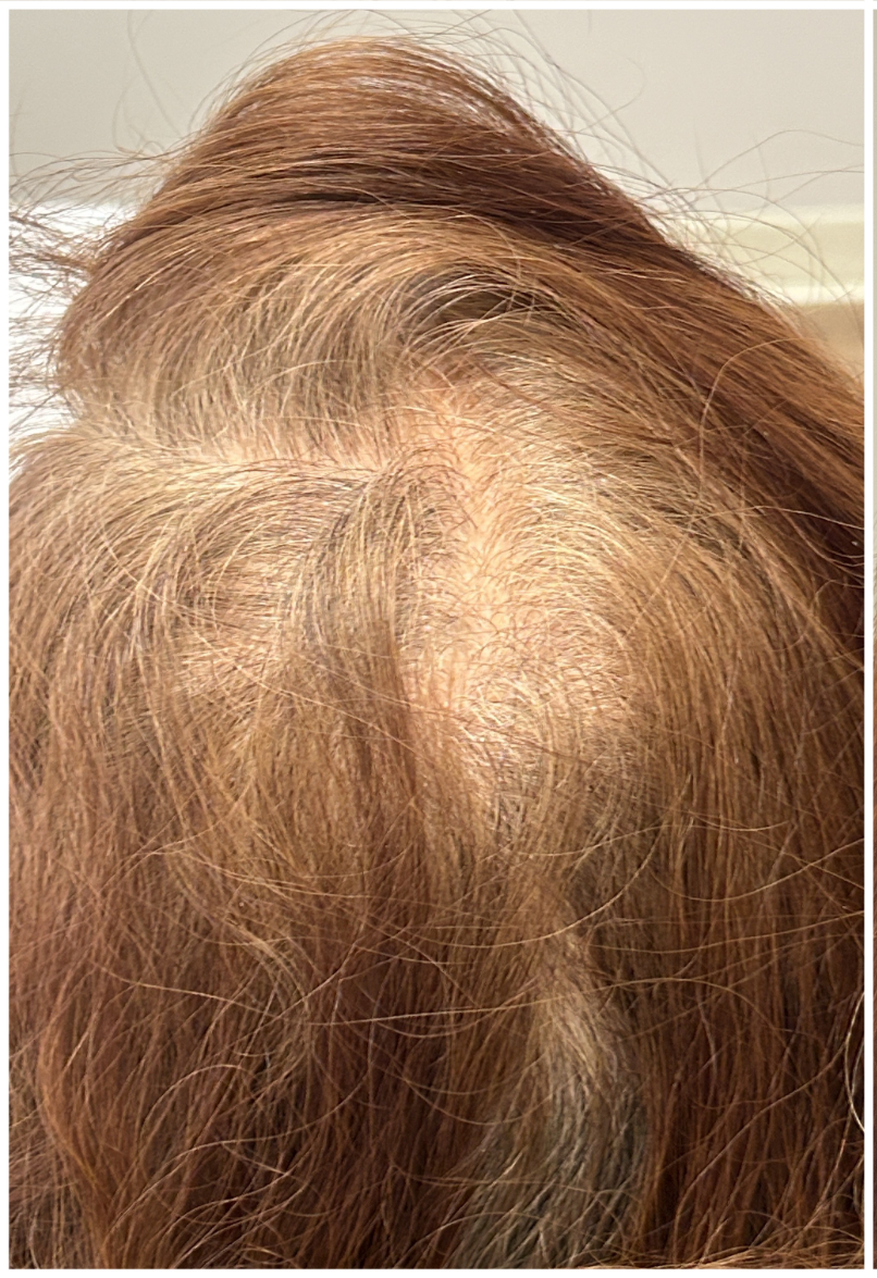 Exosome Hair Therapy before — Female Pattern Hair Loss, Crown Thinning, Hair Density Loss, front view