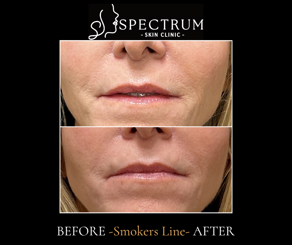 Restylane Before & After | Softening Smoker's Lines Around the Mouth