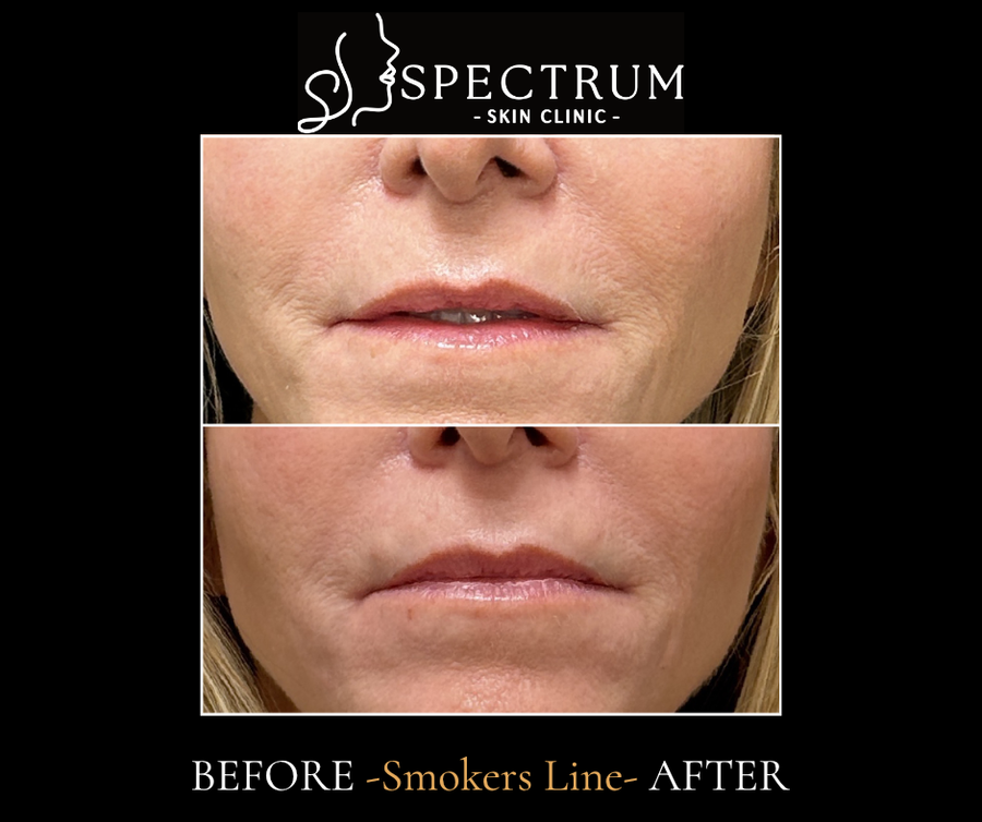 Restylane Before & After | Softening Smoker's Lines Around the Mouth