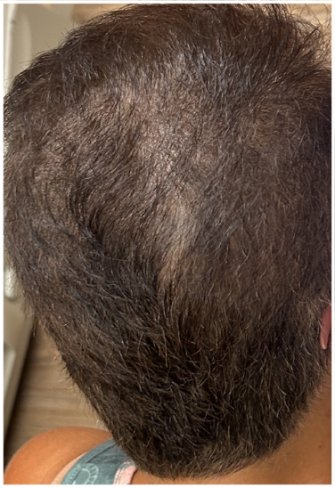 Exosome Hair Therapy before — Hair Thinning, Reduced Hair Density, Loss of Hair Volume, front view