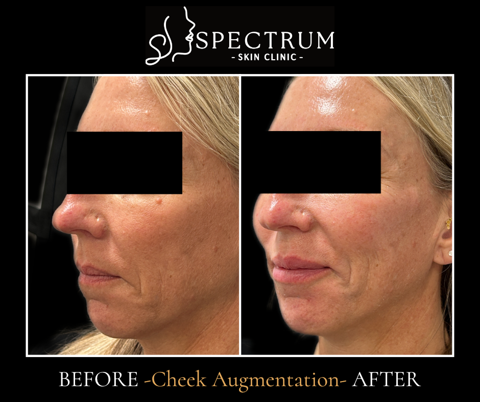 Sculptra Before & After | Cheek Augmentation and Midface Projection