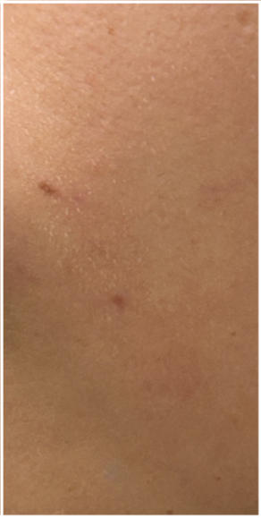 Laser Vein Removal after — Facial Veins, Spider Veins, Persistent Redness, Vascular Lesions, front view