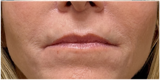 Restylane after — Smoker Lines, Perioral Lines, Vertical Lip Lines, Fine Lines and Wrinkles, Lip Definition, front view