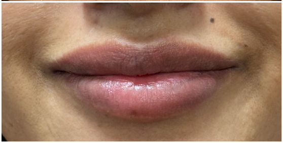 Lip Filler after — Thin Lips, Volume Loss, front view