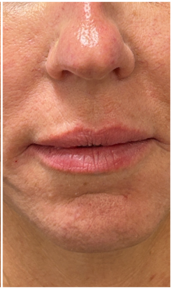 Lip Filler after — Thin Lips, Lip Volume Loss, Undefined Lip Border, Lip Asymmetry, front view