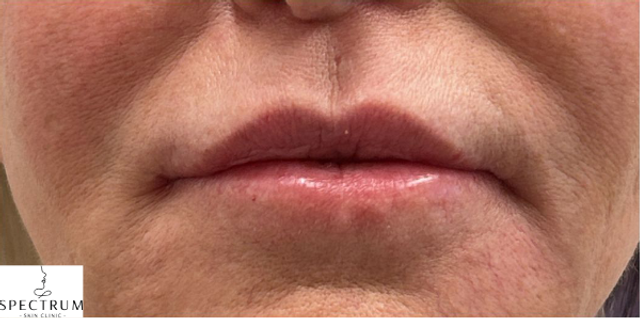 Lip Filler Before and After | Thin Lips with Perioral Fine Lines — after