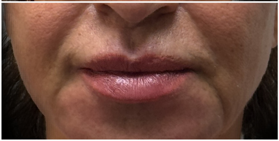 Lip Filler after — Uneven lip shape, asymmetry between left and right sides, and imbalance of the upper and lower lip, front view