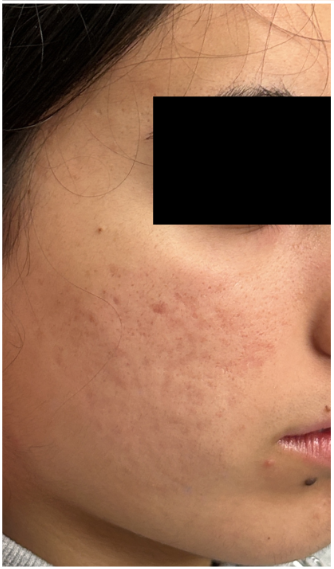 Microneedling with TCA CROSS Peel after — Acne Scars, Ice-Pick Scars, Uneven Texture, front view