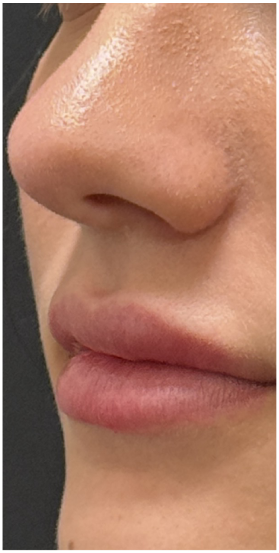 Lip Filler after — Thin Lips, front view
