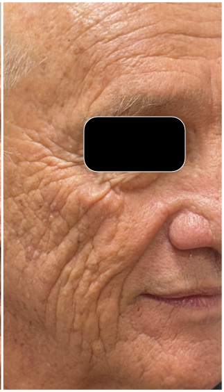 CO2 Laser Resurfacing after — Crow’s Feet, Periorbital Lines, Cheek Wrinkles, Uneven Texture, Photoaging, front view
