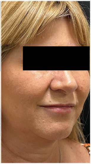 eMatrix Sublative after — Perioral Lines, Fine Lines and Wrinkles, Sagging and Laxity, Nasolabial Folds, Uneven Texture, front view