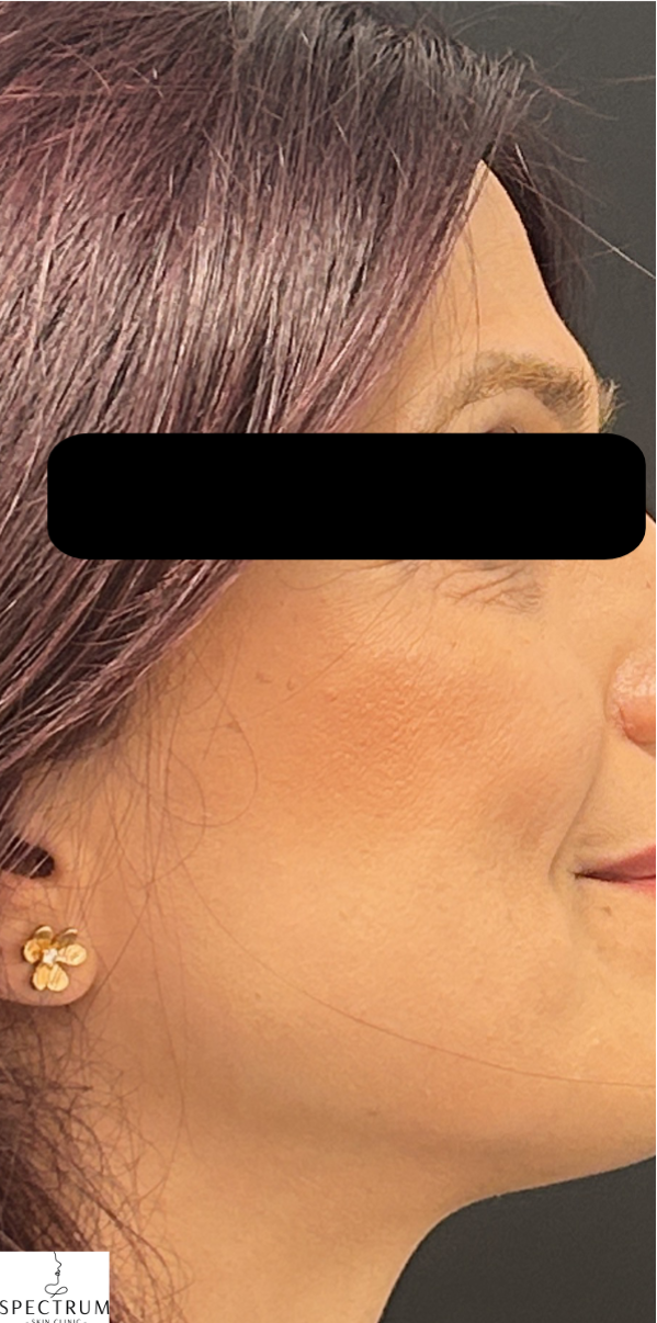 Secret PRO after — Fine Lines and Wrinkles, Uneven Texture, front view