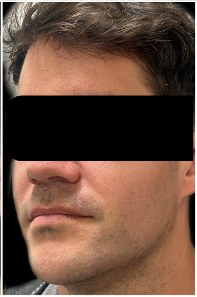 Jawline Filler, Cheek Filler, Facial Balancing after — Weak Jawline, Soft Lower Face, Lower Face Definition, Masculine Facial Definition, front view