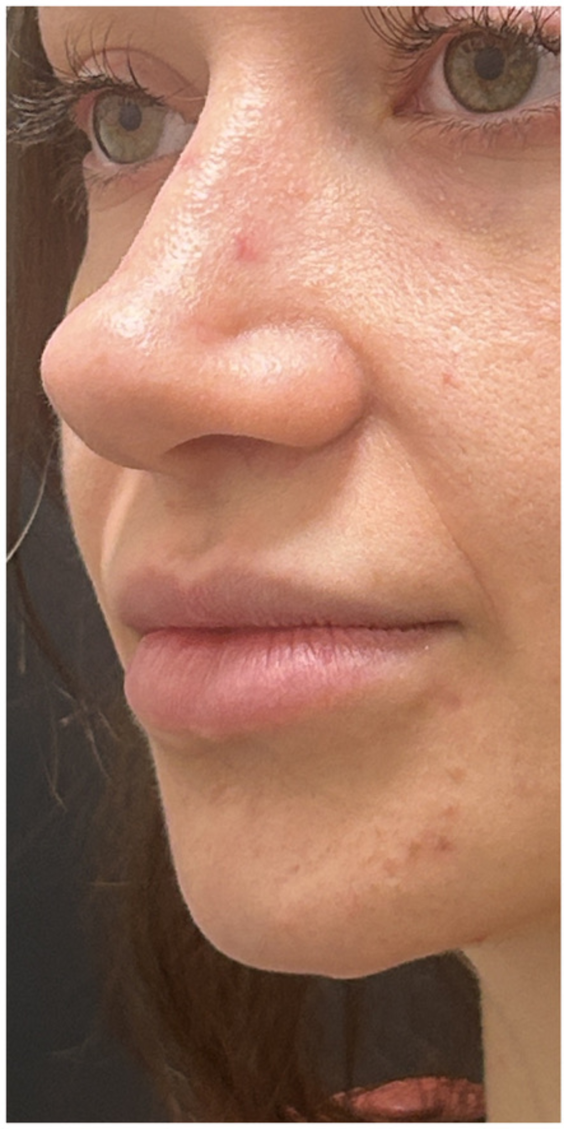 Lip Filler before — Volume and Definition, front view
