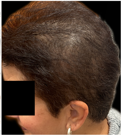 Exosome Hair Therapy after — Asymmetric Hair Thinning, Part-Line Visibility, Left-Side Crown Thinning, front view