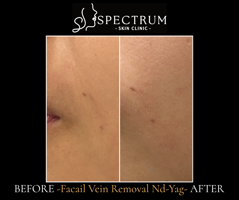 Laser Vein Removal Before & After | Facial Vessel Reduction