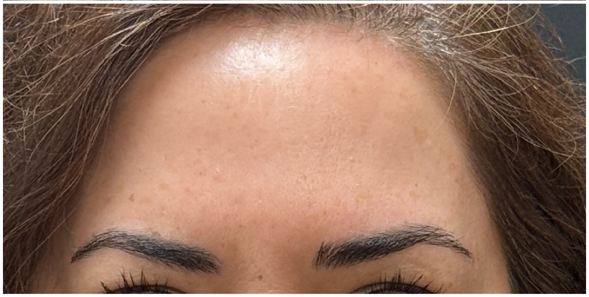 dysport after — fine-lines-wrinkles, front view