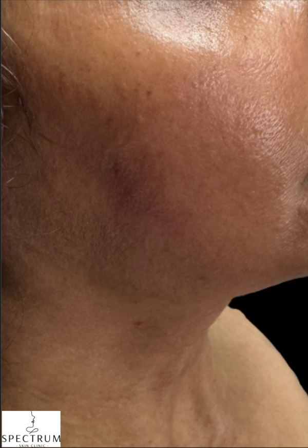 Chemical Peel before — Melasma, Hyperpigmentation, Uneven Skin Tone, Hormonal Pigmentation, front view