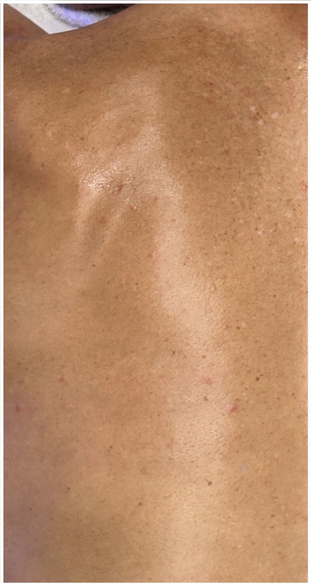 Acne Facial after — Back Acne, Body Acne, Active Acne, Comedones, front view