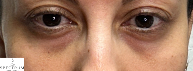 PRFM Under Eye before — Under Eye Hollows, Dark Circles, Uneven Texture, front view