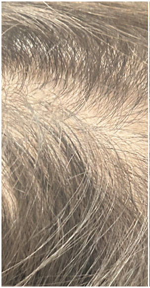 Exosome Therapy before — Part Line Thinning, Crown Thinning, front view