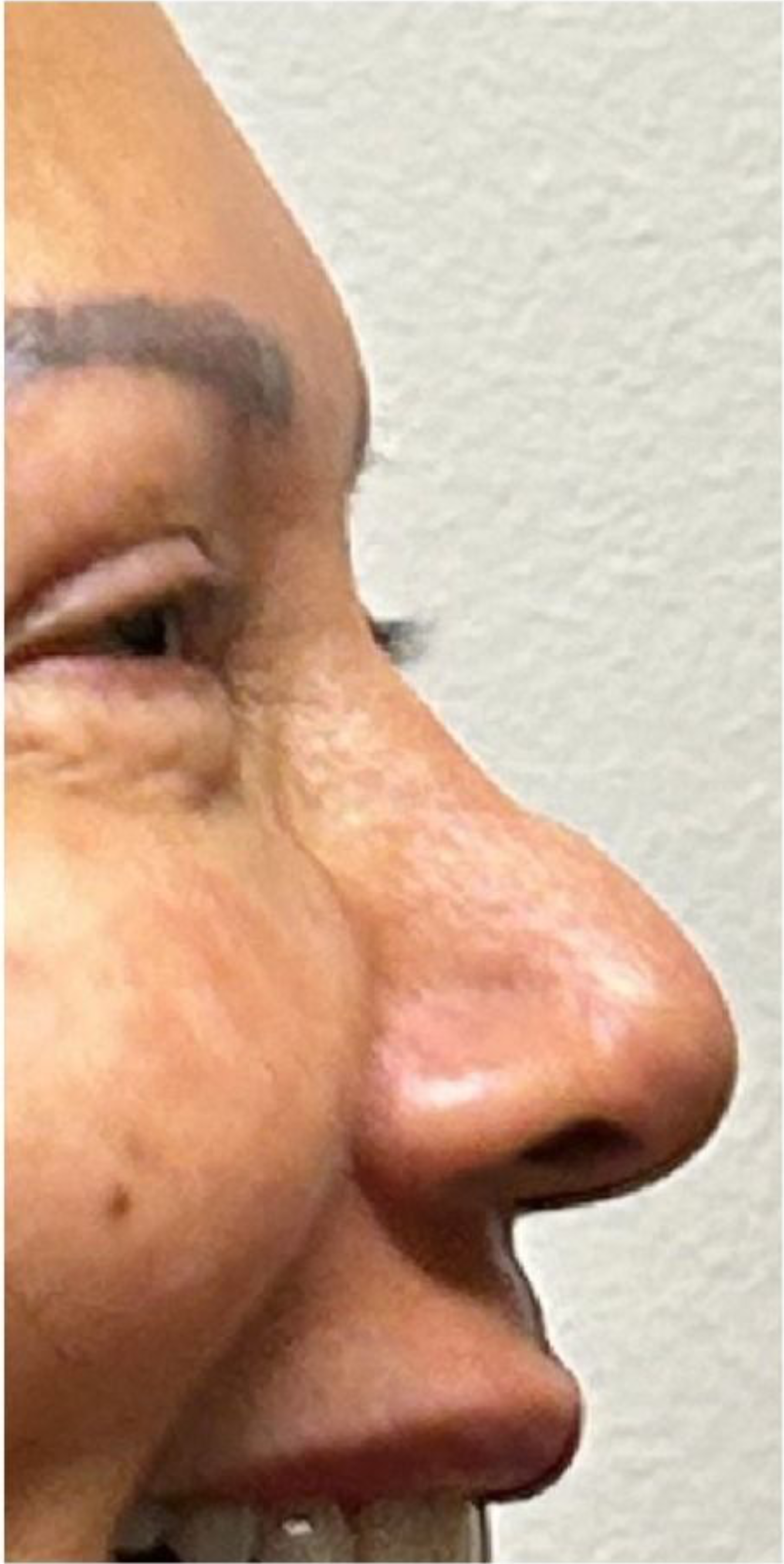 Botox after — Wide Nose, Nasal Tip Drooping, Nasal Flaring, front view