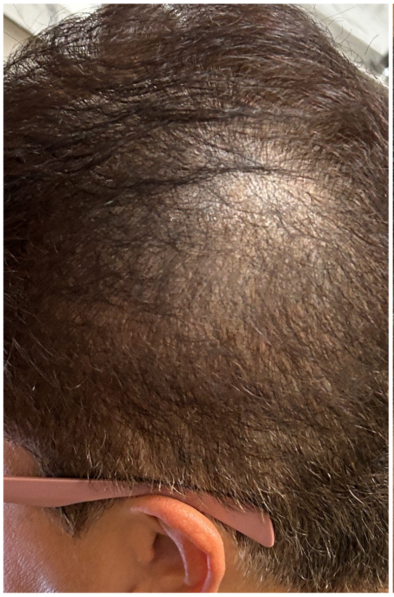 Exosome Therapy before — Female Pattern Hair Loss, Crown Density Loss, front view