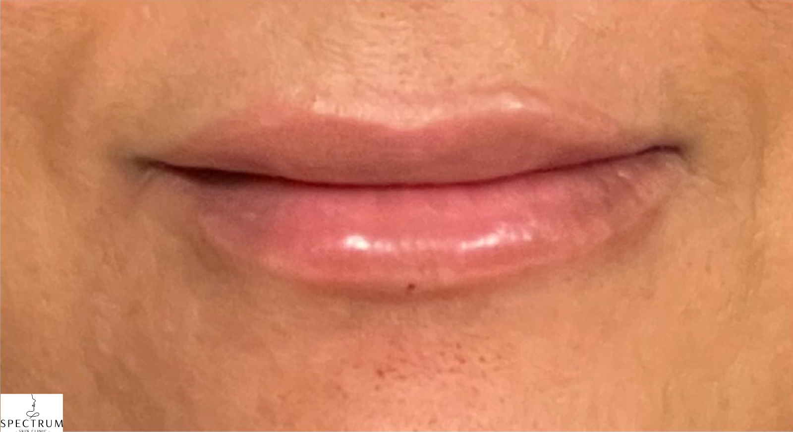 Lip Filler after — Thin Lips, front view