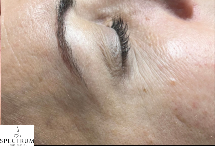 Botox after — Crow's Feet, front view