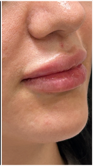 Lip Filler after — Thin Lips, front view