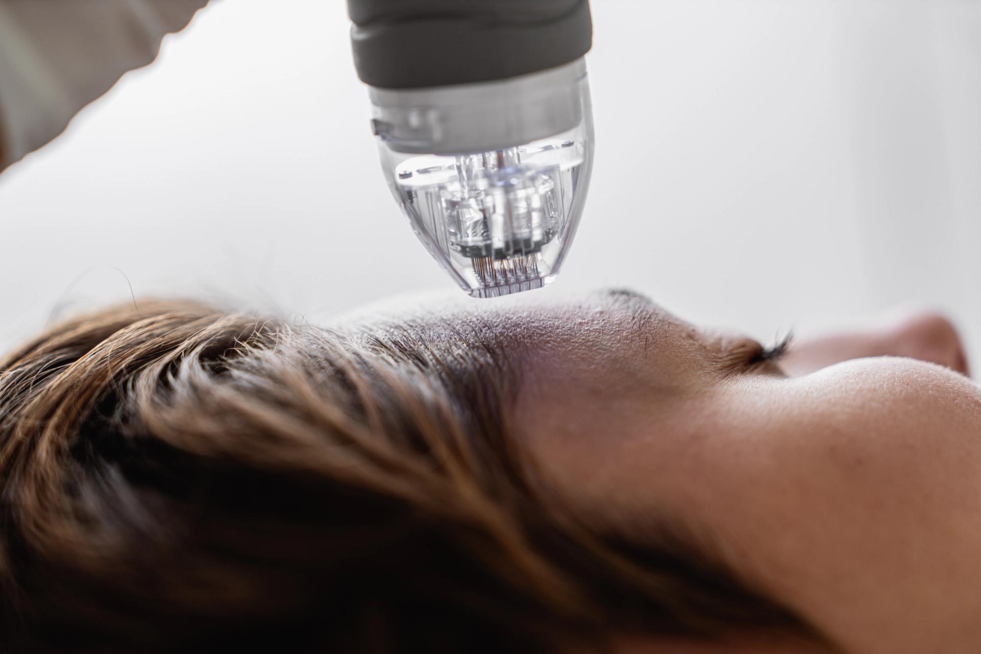 Radio Frequency Micro-needling in Irvine, CA performed by Dr. Sabeen Munib, MD