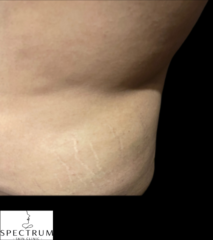 Kybella after — Double Chin, Submental Fullness, Submental Fat, front view