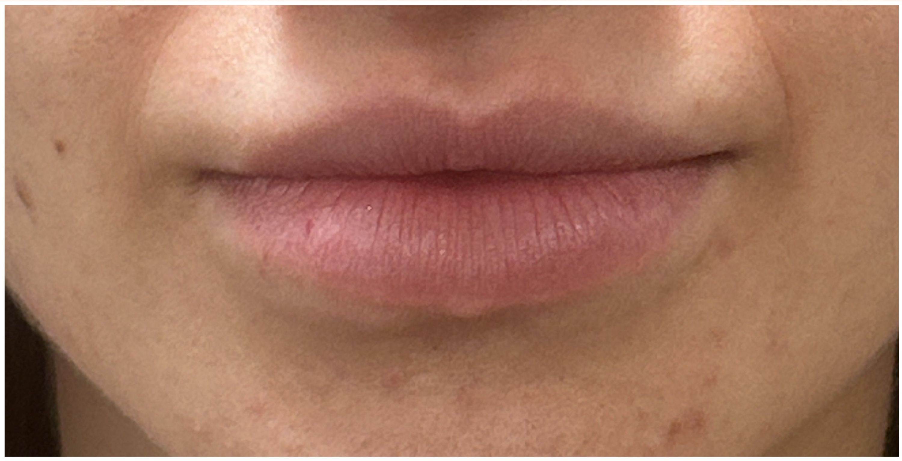 Lip Filler before — Thin Lips, front view