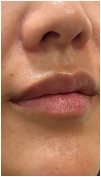 Lip Filler Dissolve after — Filler Migration, front view