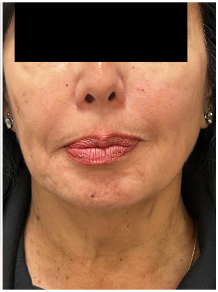 Nefertiti Botox after — Jawline Blurring, Lower Face Sagging, Neck Band Activity, Loss of Lower-Face Definition, front view
