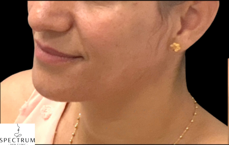 Nasolabial Fold Filler before — Nasolabial Folds, Midface Volume Loss, front view