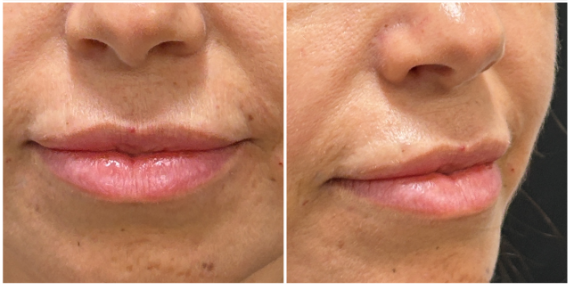 Lip Filler after — Thin Lips, Perioral Aging, Lip Lines, Fine Lines, Wrinkles, front view