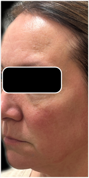 Light & Bright IPL after — Sun Damage, Hyperpigmentation, Facial Redness, Uneven Skin Tone, front view