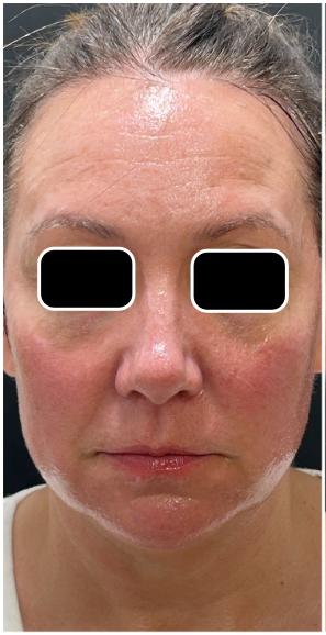 Light & Bright IPL before — Sun Damage, Hyperpigmentation, Facial Redness, Uneven Skin Tone, front view