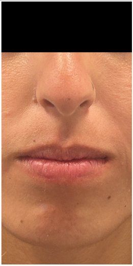 Lip Filler before — Lip Volume, Lip Symmetry, Lip Definition, front view