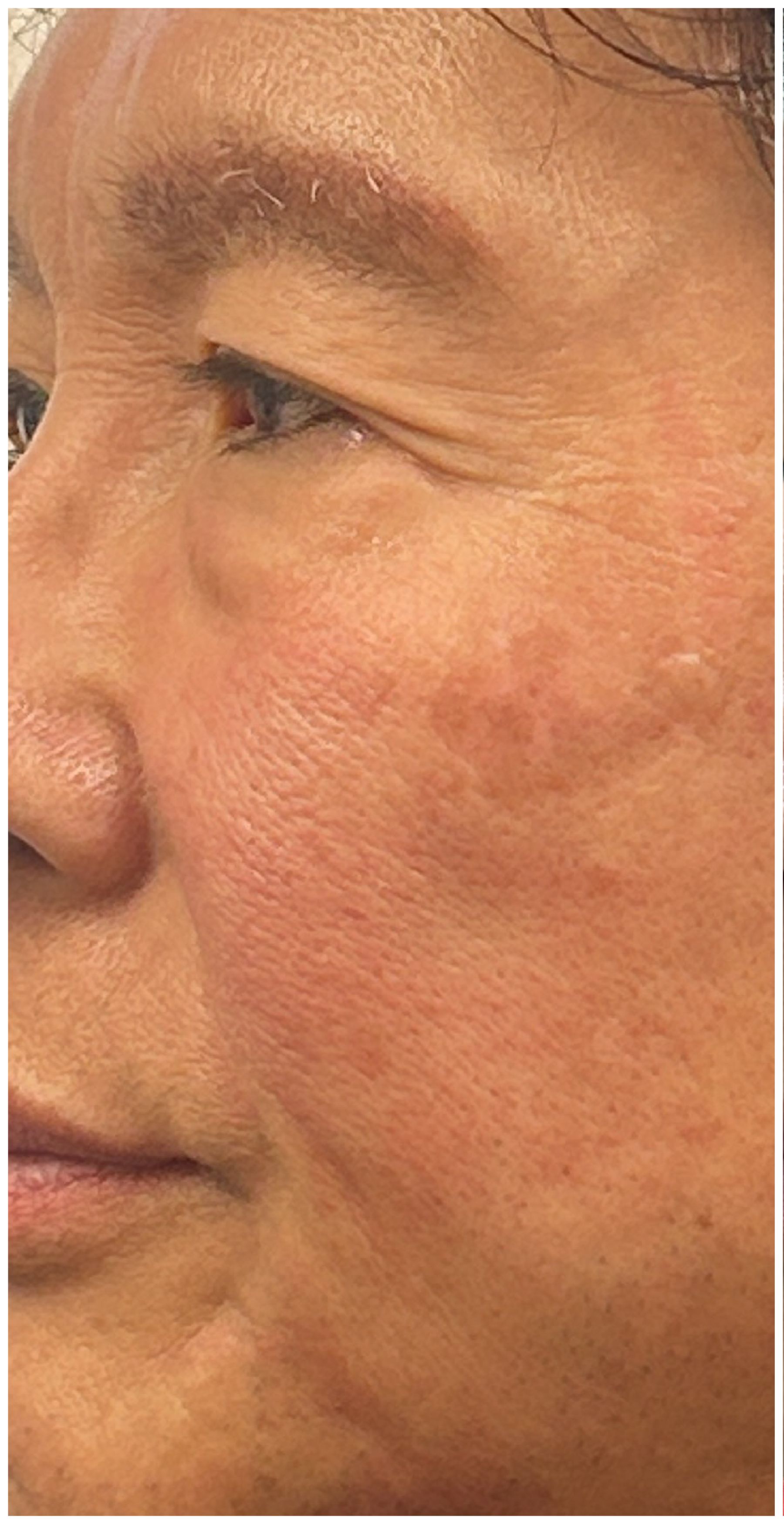 IPL Photofacial, Nordlys IPL before — Sun Damage, Hyperpigmentation, Solar Lentigines, Uneven Skin Tone, front view