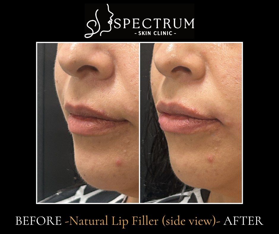 Natural Lip Filler Before & After | Side View