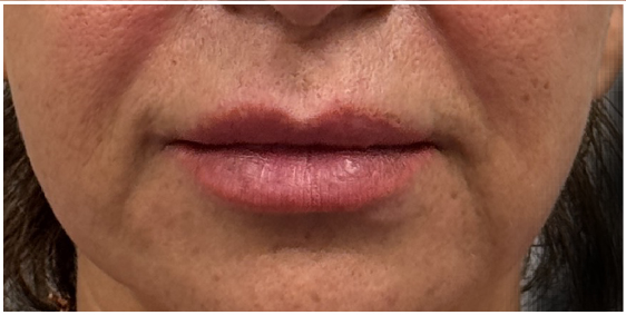 Lip Filler before — Uneven lip shape, asymmetry between left and right sides, and imbalance of the upper and lower lip, front view